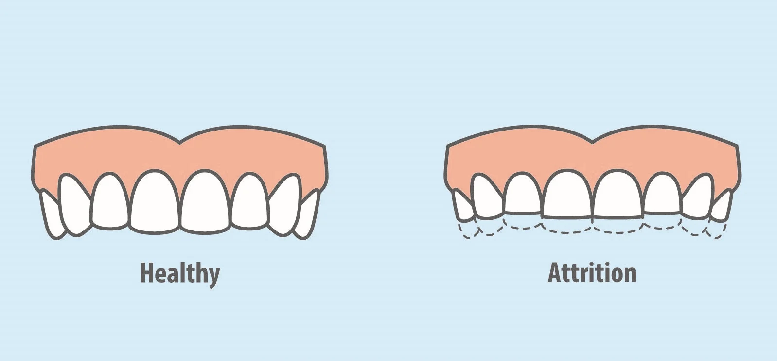 Understanding Attrition: Causes, Impacts, and Solutions