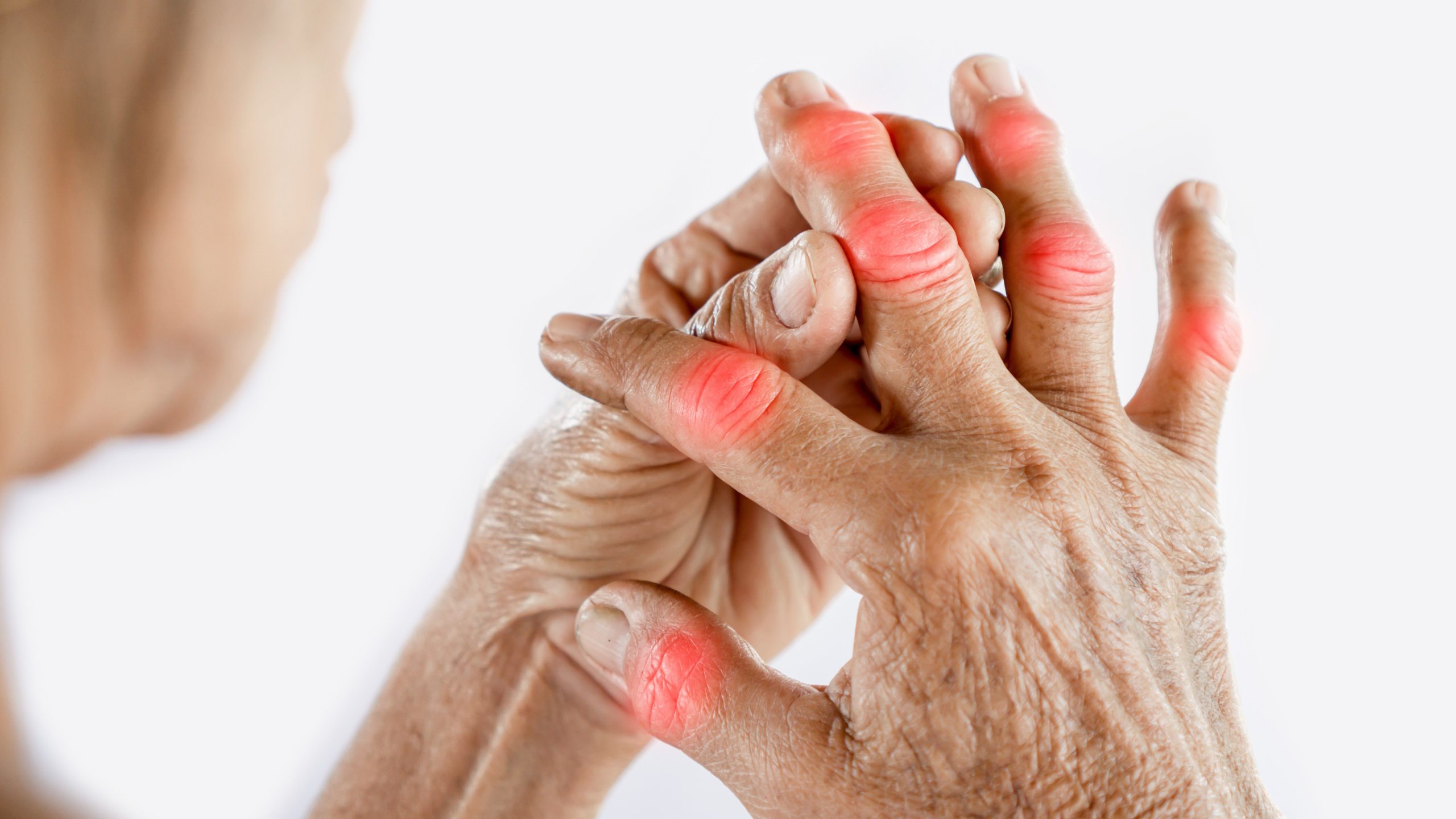 Understanding Arthritis: Impacts, Causes, and Solutions